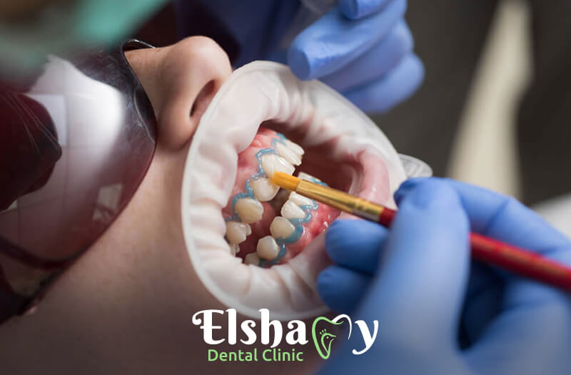 تبييض الاسنان بالليزر